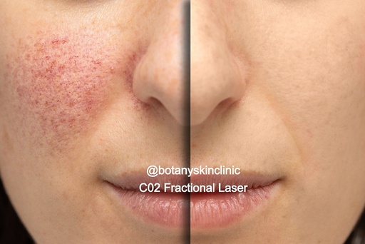 CO2 And Frax Laser
